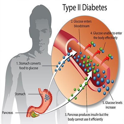 Type 2 Diabetes