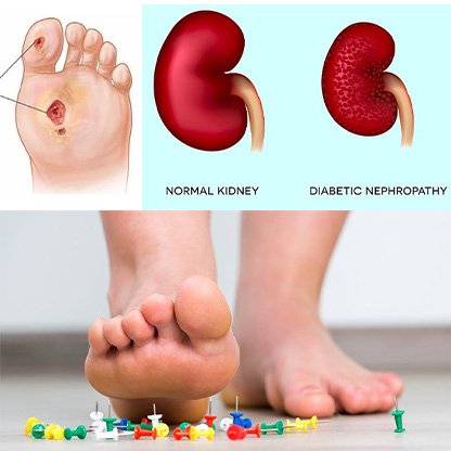 Diabetes Complications